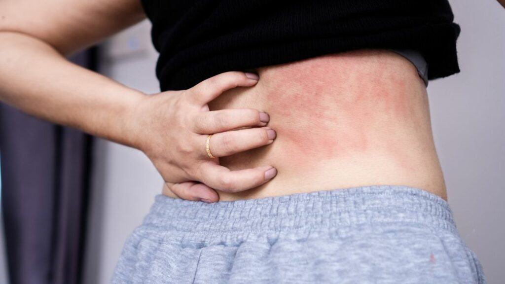 Online Treatment for Dermatitis